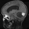 22A2 Astrocytoma, pilocytic (Case 22) T1 W 2 - Copy