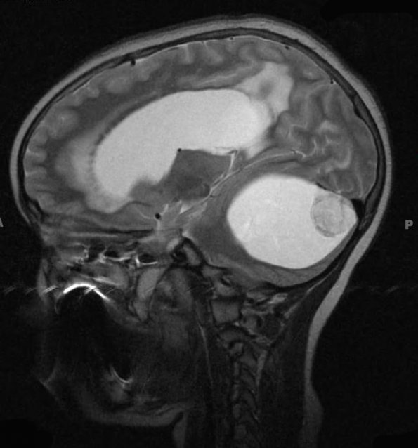 22A3 Astrocytoma, pilocytic (Case 22) T2 W - Copy