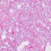 22B1 Astrocytoma, pilocytic (Case 22) H&E 4