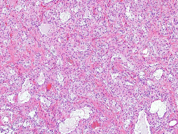 22B1 Astrocytoma, pilocytic (Case 22) H&E 4