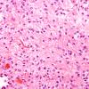 22B2 Astrocytoma, pilocytic (Case 22) H&E 2