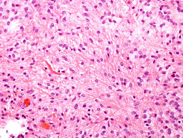22B2 Astrocytoma, pilocytic (Case 22) H&E 2