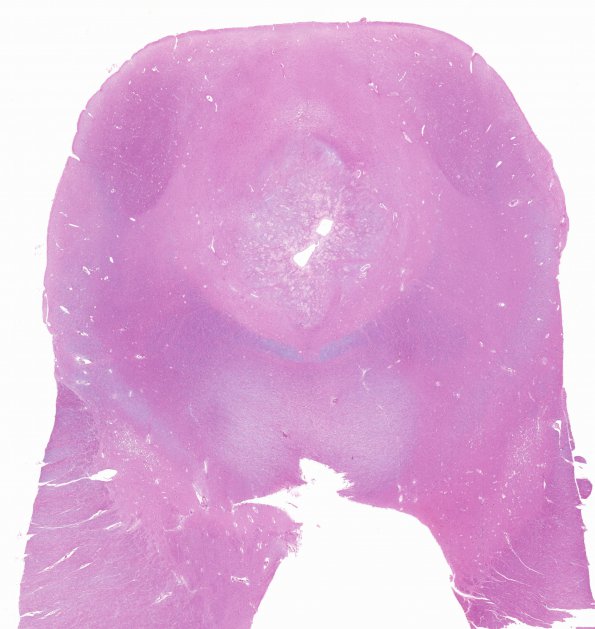 23A2 Astrocytoma, pilocytic, (Case 23) periaqueductal N24 H&E 1