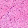 23A3 Astrocytoma, pilocytic, (Case 23) periaqueductal H&E 3