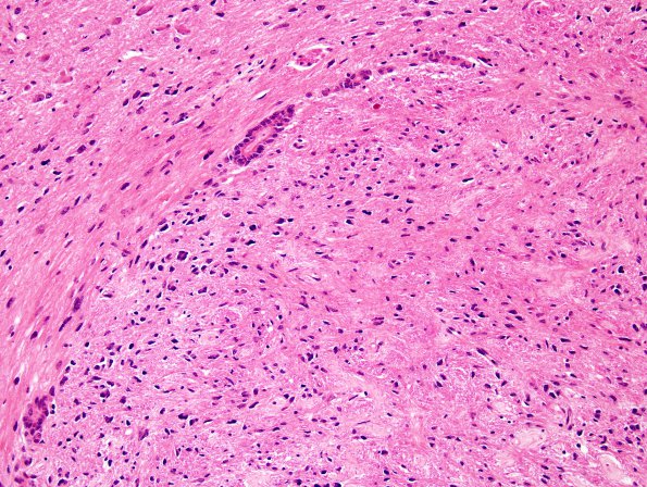 23A3 Astrocytoma, pilocytic, (Case 23) periaqueductal H&E 3