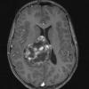 24A1 Astrocytoma, pilocytic (Case 24) T1 W 3 - Copy