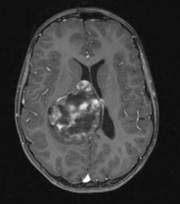 24A1 Astrocytoma, pilocytic (Case 24) T1 W 3 - Copy