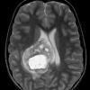 24A2 Astrocytoma, pilocytic (Case 24) T2 W - Copy