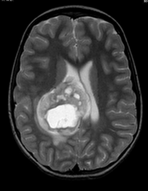 24A2 Astrocytoma, pilocytic (Case 24) T2 W - Copy