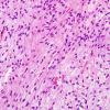 24B1 Astrocytoma, pilocytic (Case 24) H&E 5