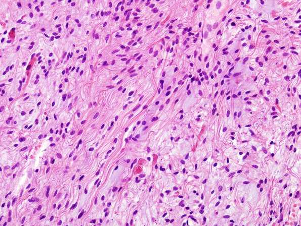 24B1 Astrocytoma, pilocytic (Case 24) H&E 5