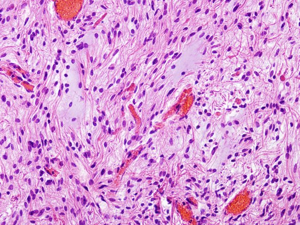 24B2 Astrocytoma, pilocytic (Case 24) H&E 6