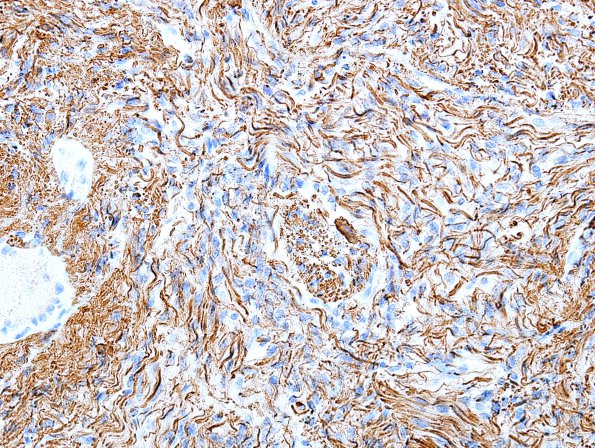 24C Astrocytoma, pilocytic (Case 24) GFAP