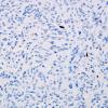 24D Astrocytoma, pilocytic (Case 24) MIB