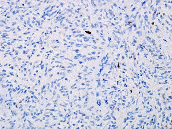 24D Astrocytoma, pilocytic (Case 24) MIB