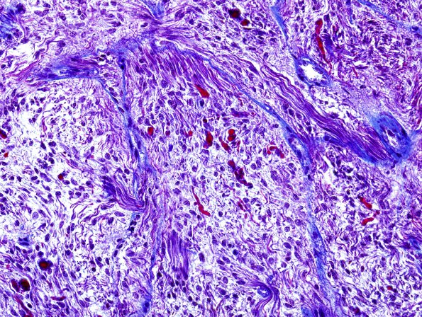 24E Astrocytoma, pilocytic (Case 24) Trichrome 4