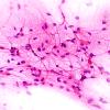 25A1 Astrocytoma, pilocytic (Case 25) smear H&E 1