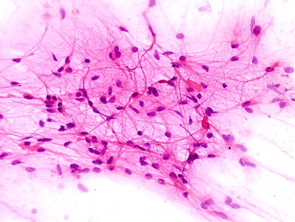 25A1 Astrocytoma, pilocytic (Case 25) smear H&E 1