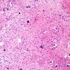 25A2 Astrocytoma, pilocytic (Case 25) H&E 1