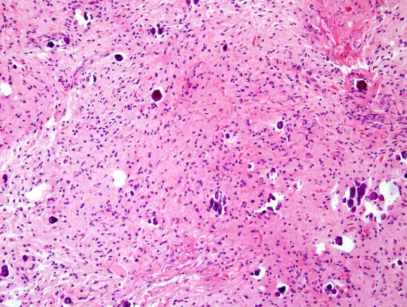 25A2 Astrocytoma, pilocytic (Case 25) H&E 1