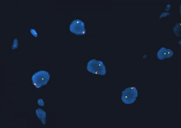 25B Astrocytoma, pilocytic (Case 25) BRAF Rearrangement - Copy