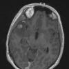 26A 1Astrocytoma, pilocytic (Case 26) T1 W 3 - Copy