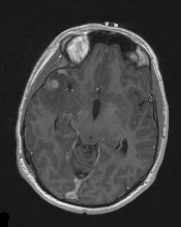 26A 1Astrocytoma, pilocytic (Case 26) T1 W 3 - Copy