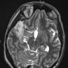 26A2 Astrocytoma, pilocytic (Case 26) T2 W - Copy