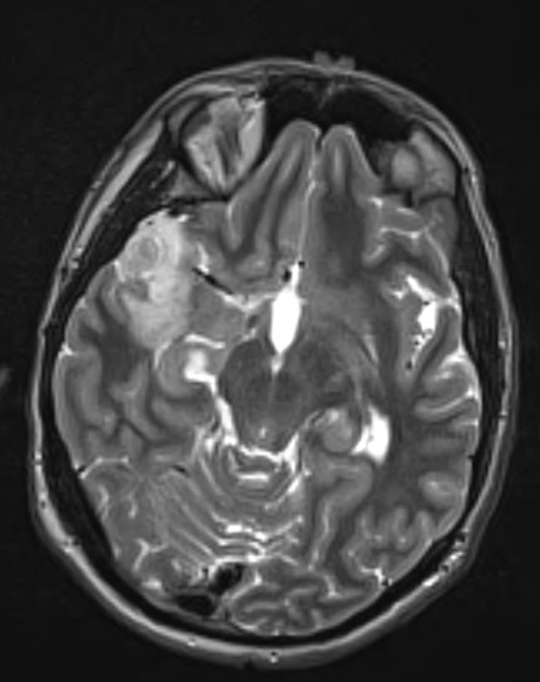 26A2 Astrocytoma, pilocytic (Case 26) T2 W - Copy