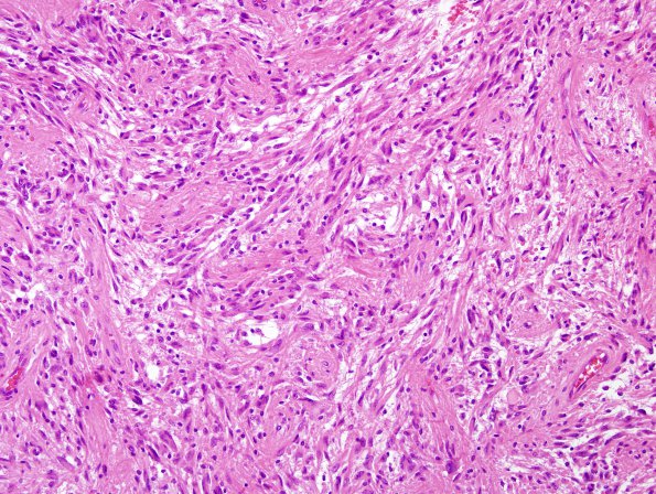 26B1 Astrocytoma, pilocytic (Case 26) H&E 8