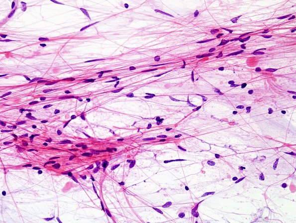 27A1  Astrocytoma, pilocytic (Case 27) H&E smear 6