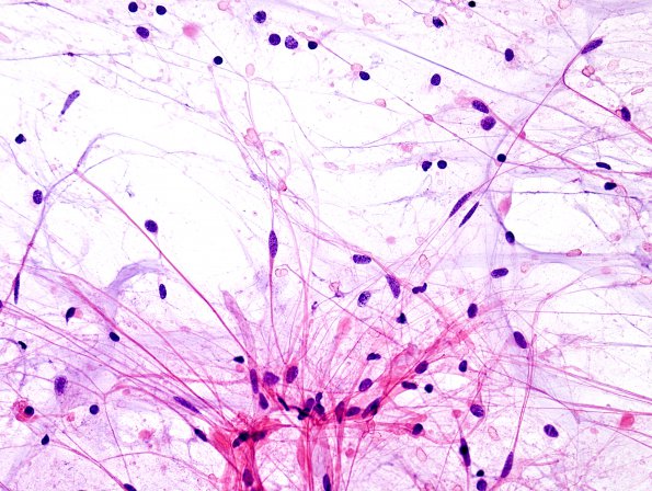 27A2  Astrocytoma, pilocytic (Case 27) H&E smear 7