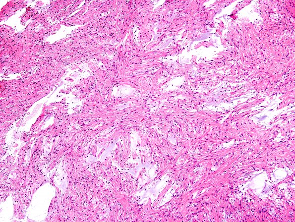 27A3  Astrocytoma, pilocytic (Case 27) H&E 3