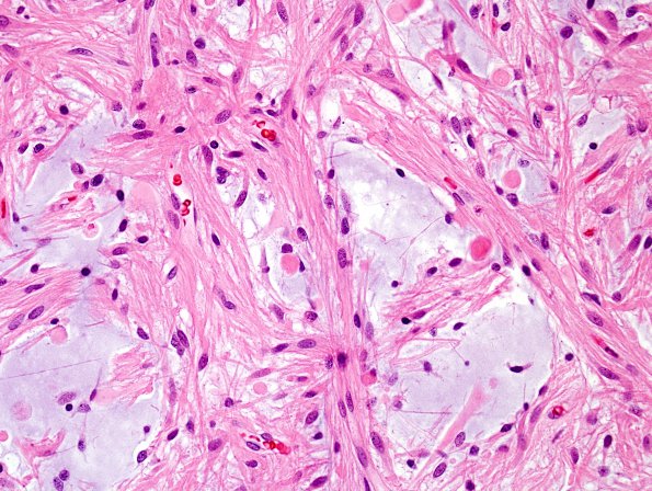 27A4  Astrocytoma, pilocytic (Case 27) H&E 10