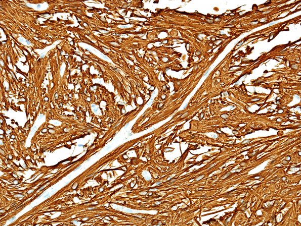 27B Astrocytoma, pilocytic (Case 27) GFAP 4