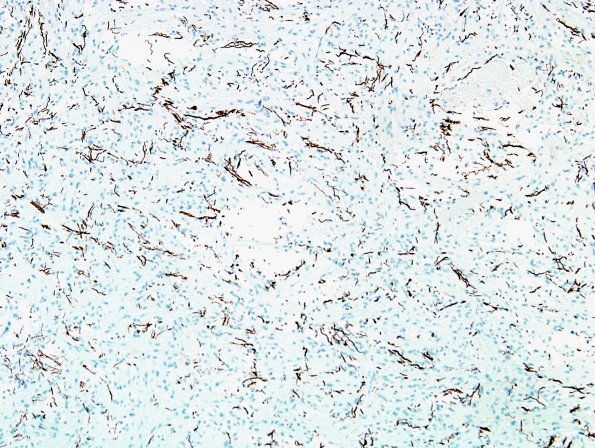 27C Astrocytoma, pilocytic (Case 27) NF