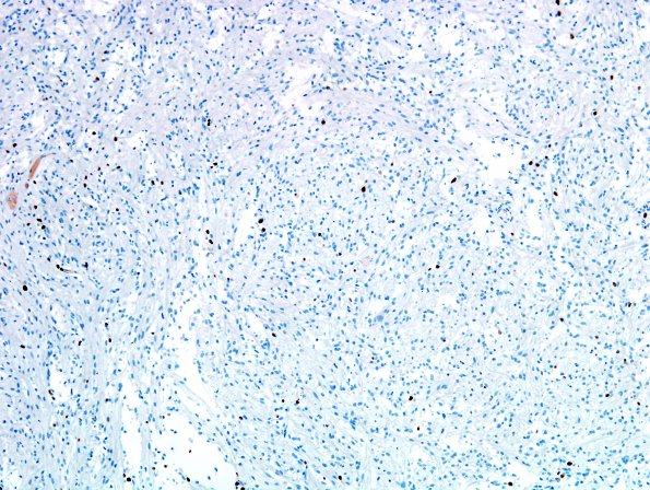 27D Astrocytoma, pilocytic (Case 27) Ki67