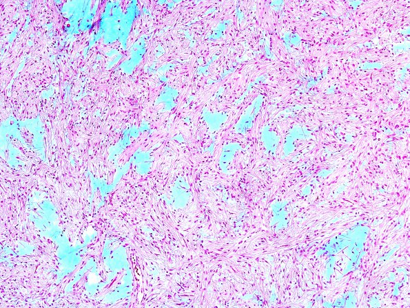 27E1 Astrocytoma, pilocytic (Case 27) Alcian Blue 9A