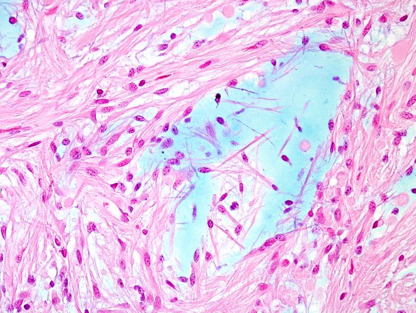 27E2 Astrocytoma, pilocytic (Case 27) Alcian Blue 1