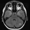 28A Astrocytoma, pilocytic (Case 28) Flair 1 - Copy