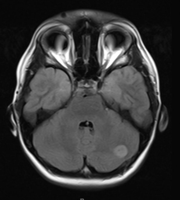 28A Astrocytoma, pilocytic (Case 28) Flair 1 - Copy