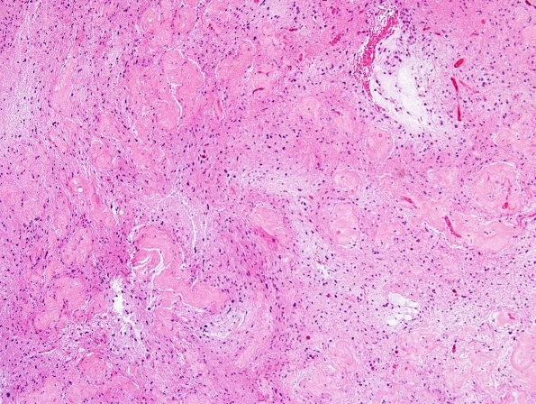 28B Astrocytoma, pilocytic (Case 28) H&E 2