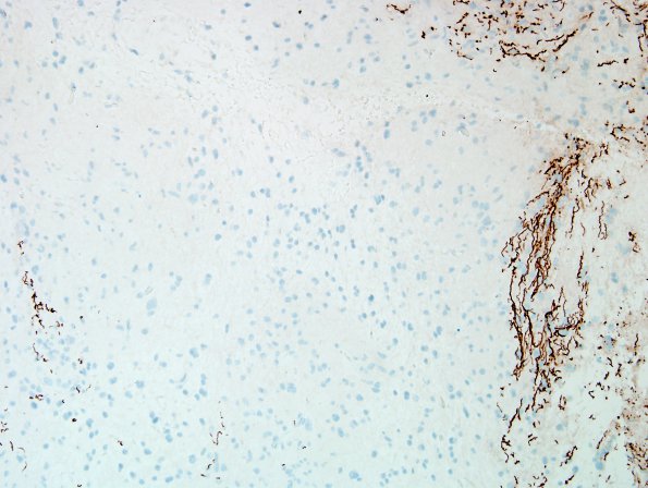 28D Astrocytoma, pilocytic (Case 28) NF