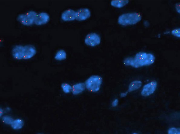 28E Astrocytoma, pilocytic (Case 28) BRAF Positive A - Copy