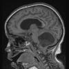 29A1 Astrocytoma, pilocytic, tons (Case 29) T1 1 - Copy