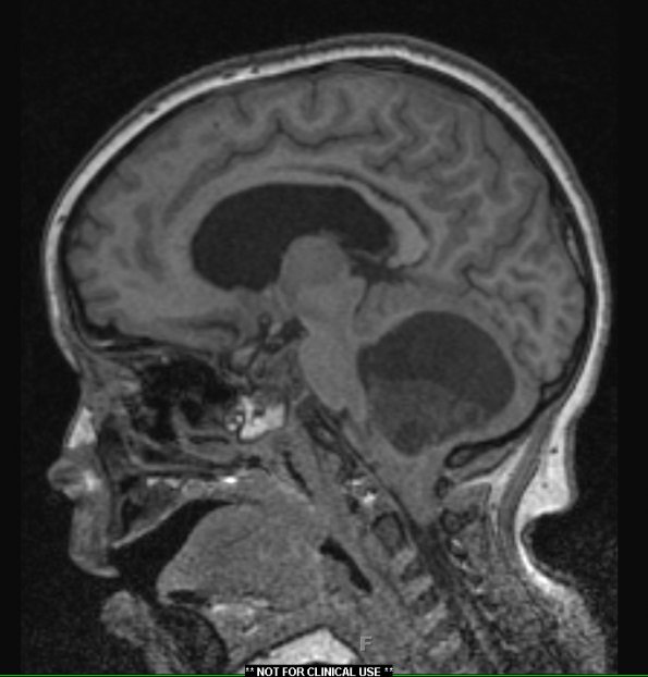 29A1 Astrocytoma, pilocytic, tons (Case 29) T1 1 - Copy