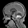 29A2 Astrocytoma, pilocytic, tons (Case 29) T1 W2 - Copy