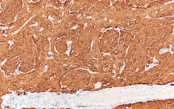 29C (Case 29) GFAP 20X