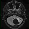 2A1 Astrocytoma, pilocytic (Case 2) FLAIR 1 - Copy