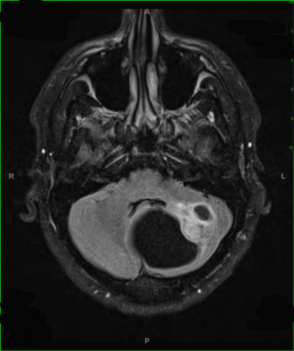 2A1 Astrocytoma, pilocytic (Case 2) FLAIR 1 - Copy